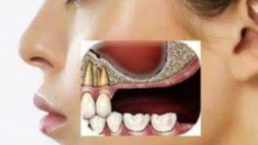 maxillary sinus lift used in dental implants