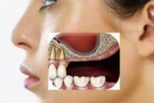 maxillary sinus lift used in dental implants